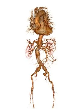 CTA abdominal aorta 3D rendering image  with stent graft . Stock Illustration