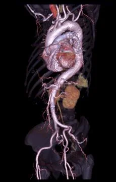 CTA abdominal aorta 3D rendering image  on transparent skeletal . Stock Illustration