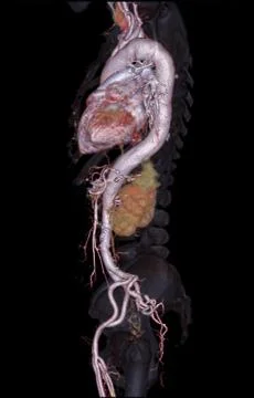 CTA abdominal aorta 3D rendering image  on transparent skeletal . 스톡 일러스트