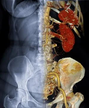 CTA ABDOMINAL AORTA  3D rendering fusion with  X-ray Abdomen image. Stock Illustration