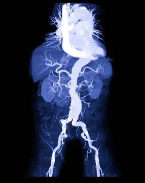 CTA abdominal aorta or CT angiography 3D mip image  showing abdominal aortic Illustrazione stock