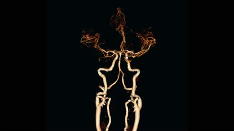 CTA brain 3D Rendering. Stock Footage 142492789