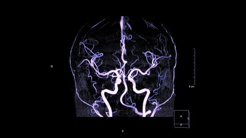 Cta brain mip Stock Footage 120862820