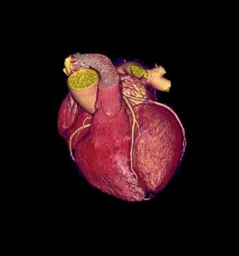 CTA Coronary artery  3D rendering image for finding coronary artery disease. Stock Illustration