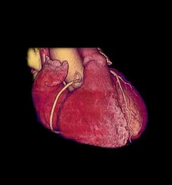 CTA Coronary artery  3D rendering image for finding coronary artery disease. Stock Illustration