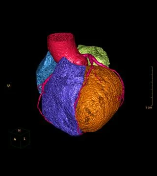 CTA Coronary artery 3D rendering image for detect coronary artery disease. Stock Illustration