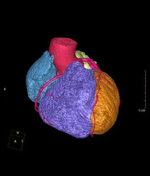 CTA Coronary artery 3D rendering image for detect coronary artery disease. Stock Illustration