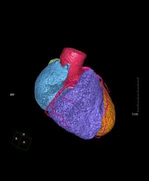 CTA Coronary artery 3D rendering image for detect coronary artery disease. Stock Illustration