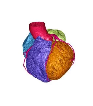 CTA Coronary artery 3D rendering image isolated on white background for detec Stock Illustration