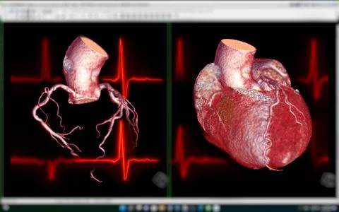 CTA Coronary artery  3D rendering image on the screen  for diagnosis of vesse Stock-Illustration