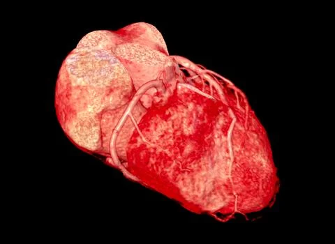 CTA Coronary artery  3D rendering image. Illustrazione stock