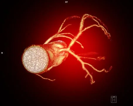 CTA Coronary artery  3D rendering image. CT angiographphy for heart disease . Stock Illustration