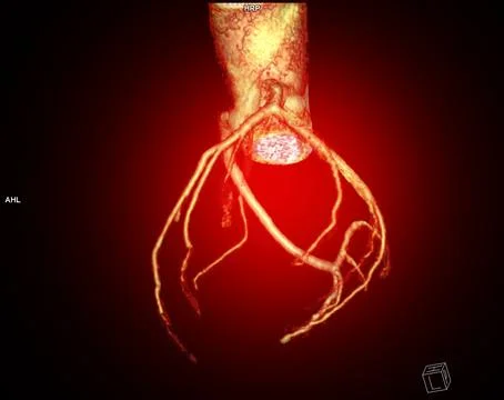 CTA Coronary artery  3D rendering image. CT angiographphy for heart disease . Stock Illustration