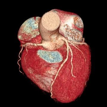CTA Coronary artery  3D rendering image. CT angiographphy for heart disease . Stock Illustration