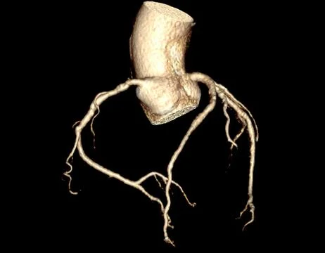 CTA Coronary artery  3D rendering image. CT angiographphy for heart disease . Stock Illustration