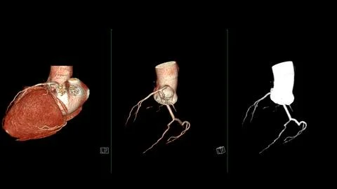 CTA coronary artery 3D rendering is a diagnostic imaging technique capturin.. Illustrazione stock