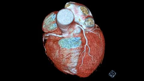 CTA coronary artery 3D rendering is a diagnostic imaging technique capturin.. Stock-Illustration
