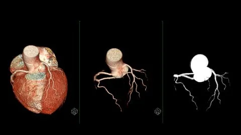 CTA coronary artery 3D rendering is a diagnostic imaging technique capturin.. Stock-Illustration