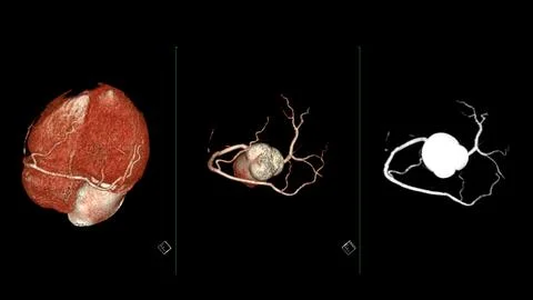 CTA coronary artery 3D rendering is a diagnostic imaging technique capturin.. Stock Illustration
