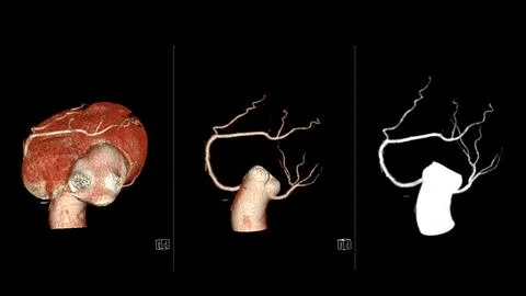 CTA coronary artery 3D rendering is a diagnostic imaging technique capturin.. Stock Illustration