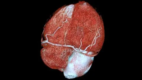 CTA coronary artery 3D rendering is a diagnostic imaging technique capturin.. Stock Illustration