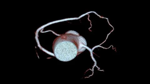 CTA coronary artery 3D rendering is a diagnostic imaging technique capturin.. Stock Illustration