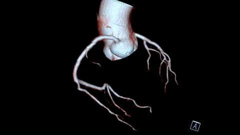 CTA coronary artery 3D rendering is a diagnostic imaging technique capturin.. Stock Illustration