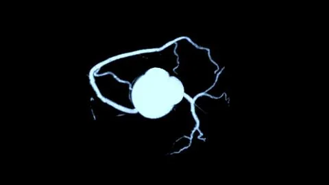 CTA coronary artery 3D rendering is a diagnostic imaging technique capturin.. Stock Illustration