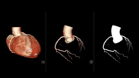 CTA coronary artery 3D rendering is a diagnostic imaging technique capturin.. Stock Illustration