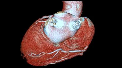 CTA coronary artery 3D rendering is a diagnostic imaging technique capturin.. Stock Illustration