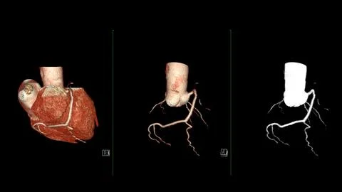 CTA coronary artery 3D rendering is a diagnostic imaging technique capturin.. Stock Illustration