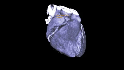 CTA Coronary artery Stock Footage 116334658