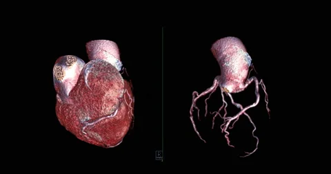 CTA Coronary artery . Stock Footage 190893012