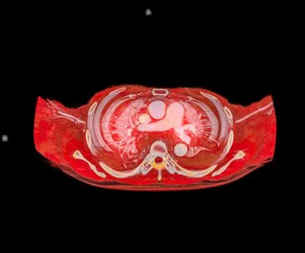 CTA pulmonary arteries 3D rendering showing branch of pulmonary artery Stock Illustration