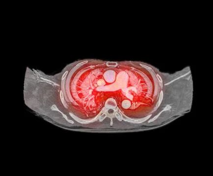 CTA pulmonary arteries 3D rendering showing branch of pulmonary artery Stock Illustration