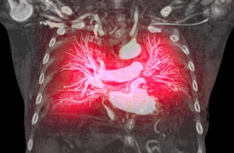 CTA pulmonary arteries 3D rendering showing branch of pulmonary artery Stock Illustration
