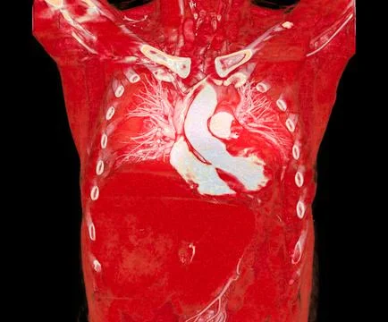 CTA pulmonary arteries 3D rendering showing branch of pulmonary artery Stock Illustration