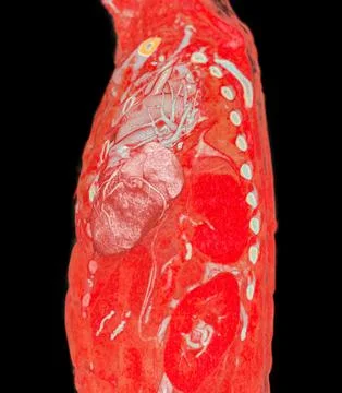CTA pulmonary arteries 3D rendering showing branch of pulmonary artery Stock Illustration