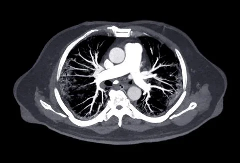 CTA pulmonary arteries 3D rendering showing branch of pulmonary artery Stock Illustration