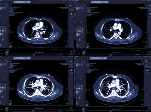 CTA pulmonary arteries 3D rendering showing branch of pulmonary artery Stock-Illustration
