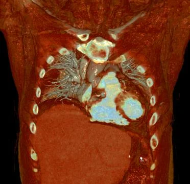 CTA thoracic aorta 3D rendering offers detailed visualization, providing cl.. Illustrazione stock