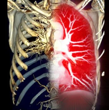 CTA thoracic aorta 3D rendering offers detailed visualization, providing cl.. Stock Illustration
