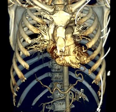 CTA thoracic aorta 3D rendering offers detailed visualization, providing cl.. Stock Illustration