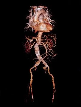 CTA whole aorta 3D rendering image  with stent graft on transparent skeletal . Stock Illustration