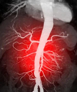 CTA whole aorta 3D rendering. Illustrazione stock
