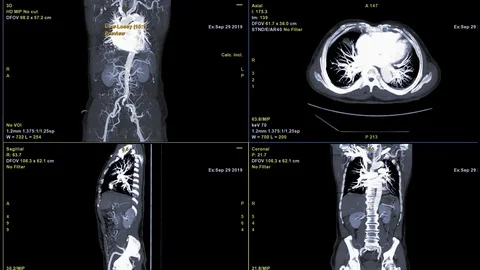 CTA Whole aorta Stock Footage 117361111