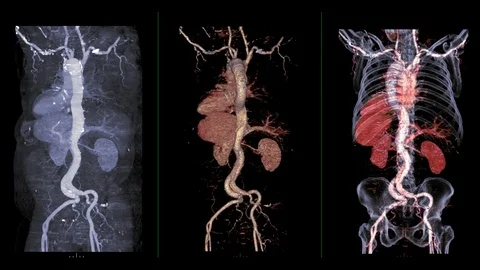 CTA Whole aorta Stock Footage 120863277