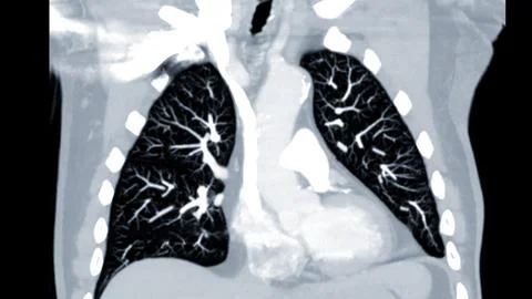 CTPA or CTA pulmonary artery .This imaging technique offers a clear view of.. Stock Illustration