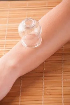 Cupping-glass on acupuncture Stock Photos