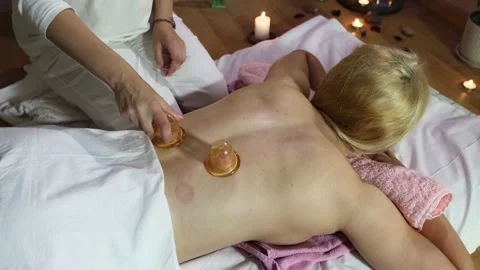 Cupping massage. Stockbeeldmateriaal 157056132